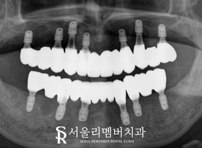 서울대입구역 치과 , 잇몸뼈 부족해도 전체 임플란트 ? 가능합니다. <증례 有> 관련 이미지 4