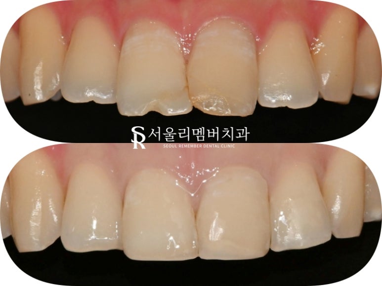 신림 치과 깨지고 길이 안 맞는 앞니 부러진 부분만 레진으로 간단하게 당일 치료 관련 이미지 6