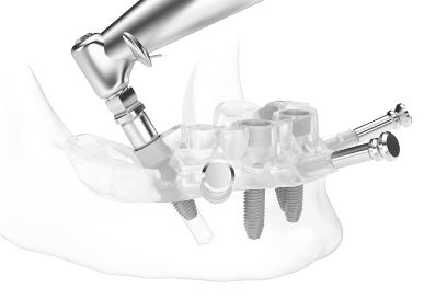 신림역 치과 "틀니는 쓰기 싫어요." 전체 임플란트 식립 후기 관련 이미지 5
