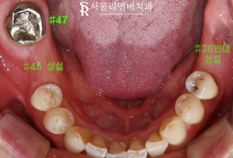 "이제 밥 먹는 것도 문제없어요!" 낙성대 치과 임플란트 로 새로운 구강 환경 찾아 드린 사례 관련 이미지 2