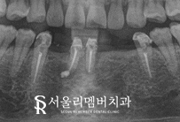 서울대입구역치과 에서 아래 앞니 5개를 임플란트 2개만으로 자연스럽게 회복 관련 이미지 6