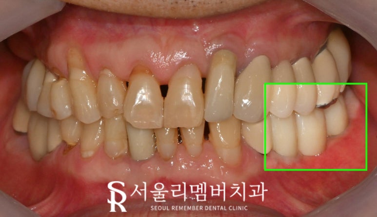 왼쪽 아래 어금니 임플란트 브릿지 장점, 진행 과정, 빨리 치료해야 되는 이유 상도동 치과 관련 이미지 5