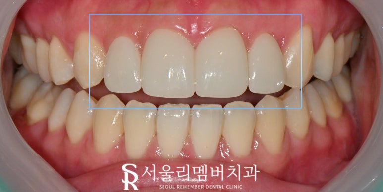 치아 크기 작은 왜소 측절치, 봉천동 치과 전치부 라미네이트로 자연치 삭제 없이 리얼하게 개선하는 방법 관련 이미지 3