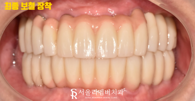 오랜 틀니 착용으로 잇몸이 다 망가졌던 분.. 임플란트 식립으로 밝은 미소 되찾아드렸습니다! 서울대입구역 서울 리멤버 치과 관련 이미지 8