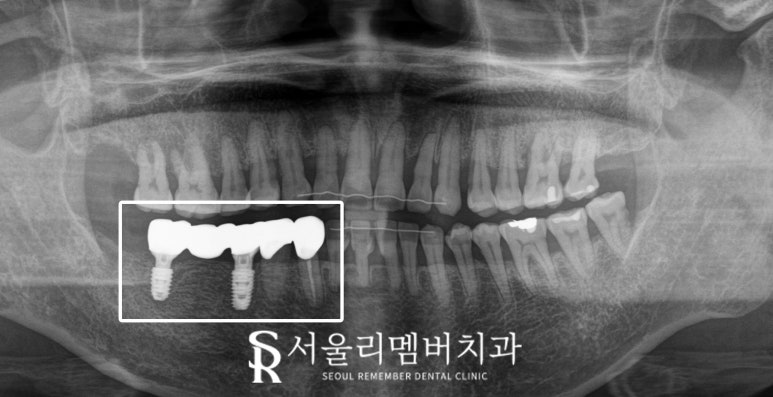 오래된 브릿지와 크라운 보철 임플란트 교체 및 사랑니 발치까지 신대방 치과 관련 이미지 4