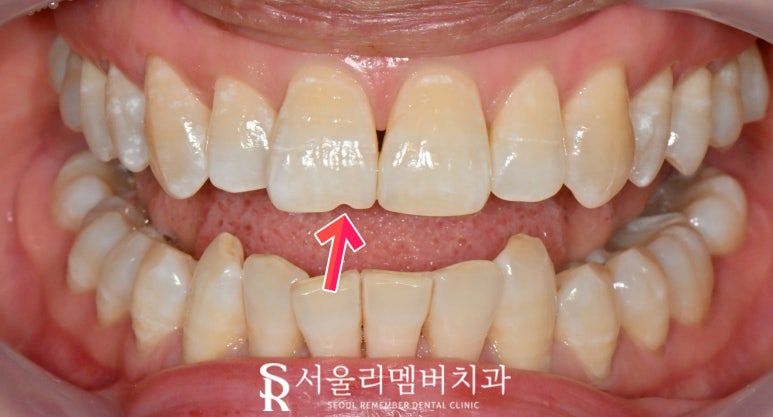 앞니 탈회 초기 충치 절단연 깨짐 치아 길이 안맞음 서울대입구 치과 전치부 리얼네이트 치료 과정 관련 이미지 2