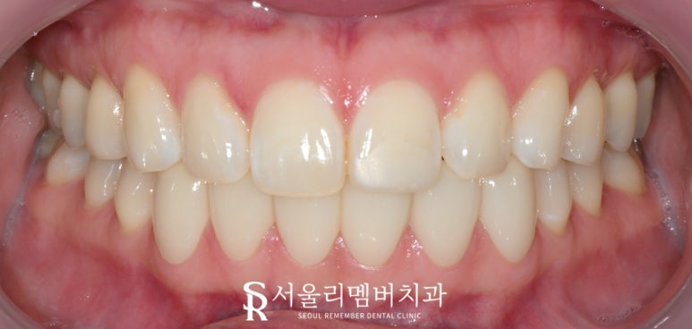 하악 전치 벌어진 공간 스페이스 해소를 위한 아래 앞니 6전치 리얼네이트 라미네이트 케이스 관련 이미지 7