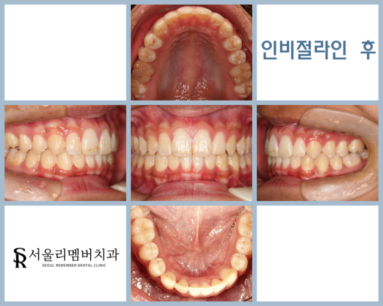 벌어지고 삐뚠 치아 교정 후 관련 이미지 1