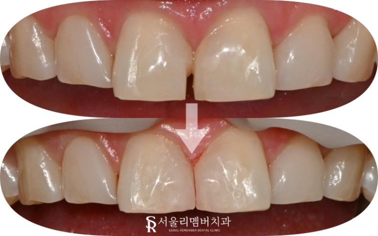 낙성대 치과 레진 탈락으로 인한 앞니 벌어짐(다이아스태마), 당일 치료 과정 관련 이미지 3