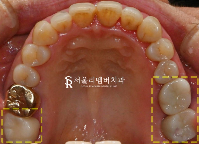 살리려던 어금니, 신경치료 시도 후 결국 임플란트로 복구한 보라매 치과 치료 사례 관련 이미지 5