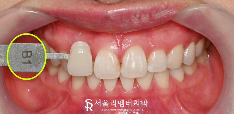 봉천역 치과 원데이 당일 치아미백 (쉐이드 가이드 기준 A2 &rarr; B1 전후 비교) 관련 이미지 2