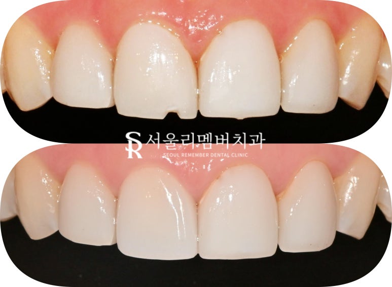 서울대입구역 치과, 깨진 앞니 라미네이트 한 개만 교체 치료 가능할까요? 관련 이미지 5