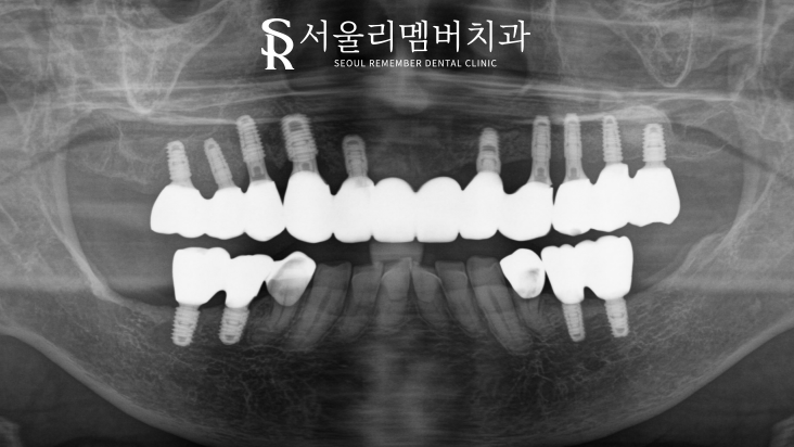 올바른 교합의 중요성, 서울대입구역치과 전체 임플란트 기간 및 과정 관련 이미지 4
