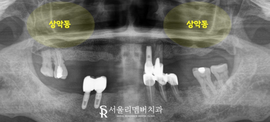서울대입구역 치과 나에게 맞는 보철은 틀니? 임플란트? 관련 이미지 5