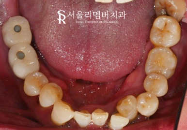 고난도 수술, 서울대입구역 임플란트 치과 에서 치료해야 되는 이유는? 관련 이미지 2