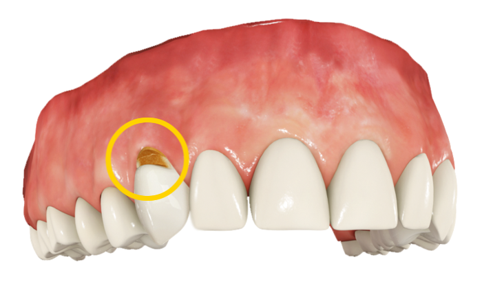 봉천역 치과 에서 레진 당일 치료로 치경부마모증(CA)를 개선해드렸습니다. 관련 이미지 3