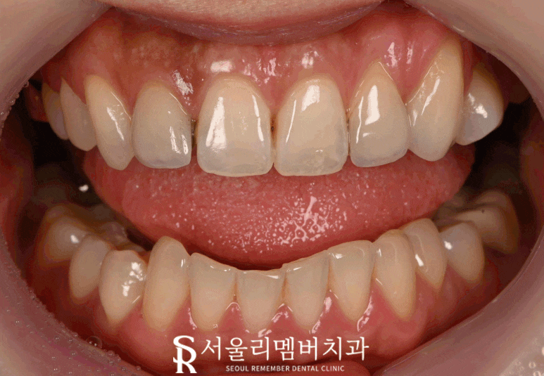 기존 라미네이트에 틈과 변색이 생겼다면? 낙성대 치과 상악 4전치 리얼네이트로 다시 완성한 앞니 관련 이미지 2