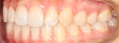 조기접촉 교정 후 관련 이미지 3