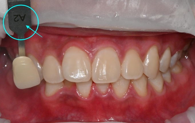 My Teeth Have Turned Yellow: The Transformation Process Through Aesthetic Professional Whitening at a Nakseongdae Station Dental Clinic image 3