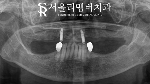 올바른 교합의 중요성, 서울대입구역치과 전체 임플란트 기간 및 과정 관련 이미지 1