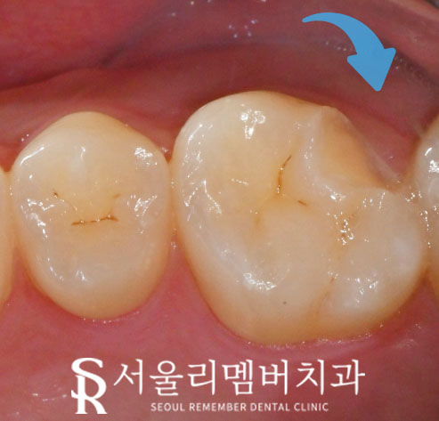 봉천역 치과 어금니 깨짐 당일 레진 치료 되는 곳, 자연스러운 외관 회복 관련 이미지 1