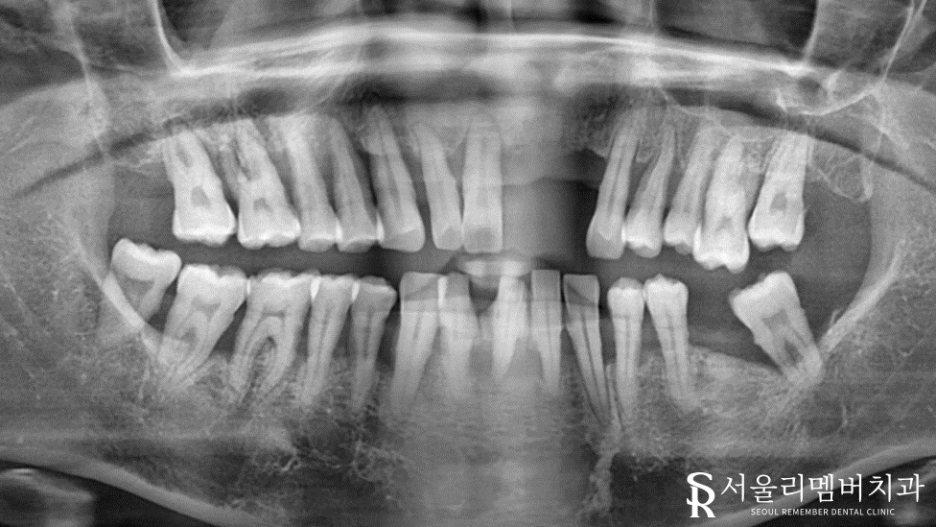 치석이 발치로 이어질 수 있다는 말, 사실일까요?! 봉천동 서울 리멤버 치과 관련 이미지 8