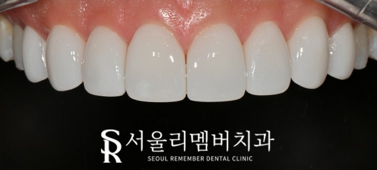 A Surge in Instagram DM Reservation Inquiries at Seoul National Univ. Entrance Station Dental Clinic: A Complete Rundown of Questions About Real Laminate image 7