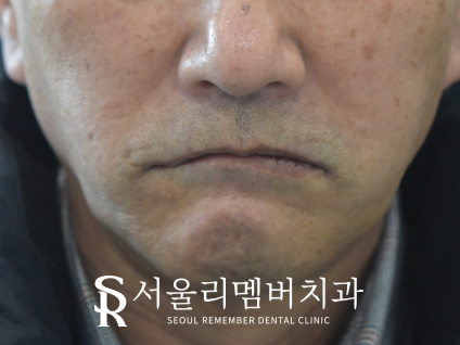 오래된 보철을 방치하면 결국 임플란트 식립밖에 남지 않게 됩니다! 봉천역 리멤버 치과 관련 이미지 10