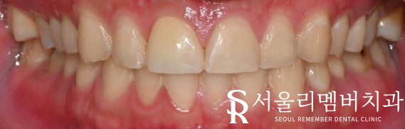 사당동 치과 에서 외상으로 인한 앞니 파절, 심미보철로 개선해 드렸습니다. 관련 이미지 3