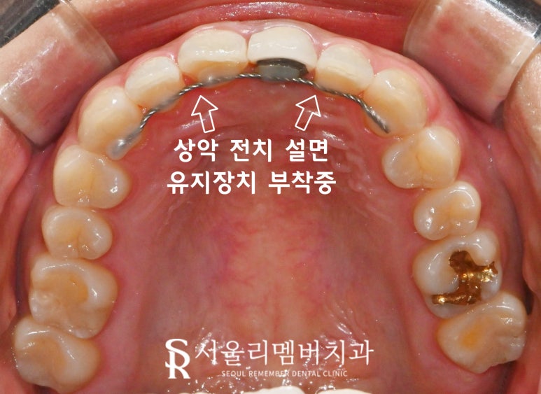 Sillim Dental Clinic: Crowded Front Teeth That Shifted Again and an Old PFM Crown, Zirconia Esthetic Prosthetic Treatment After Re-orthodontic Correction image 2