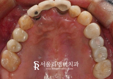 한 번에 많은 치아 치료해야 된다면? 사당역 치과 수면 임플란트 로 편안하게 관련 이미지 7