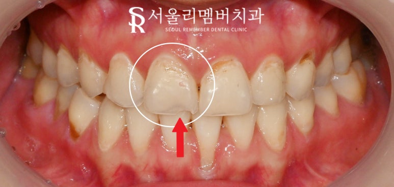 신대방 치과 앞니 끝(절단연) 약간 깨짐? 전치부 파절 레진 당일 치료 및 주의 사항 관련 이미지 2