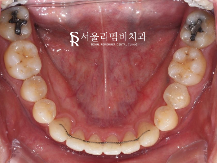 벌어진 치아, 사당 치과 인비절라인으로 개선할 수 있을까? 관련 이미지 12
