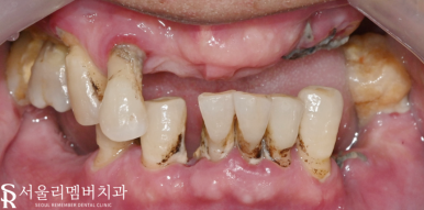 여러 곳이 결손된 치아 서울대입구역 치과 에서 다수 임플란트 식립으로 불편감을 개선해 드린 케이스 관련 이미지 2