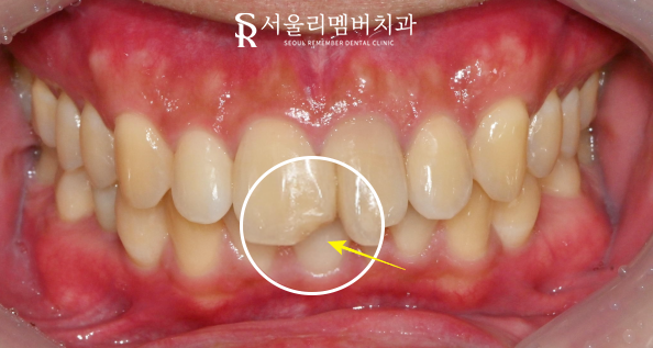 서울대입구 치과 앞니 절단연 파절 레진 당일 충전 진행 과정 및 관리법 관련 이미지 1