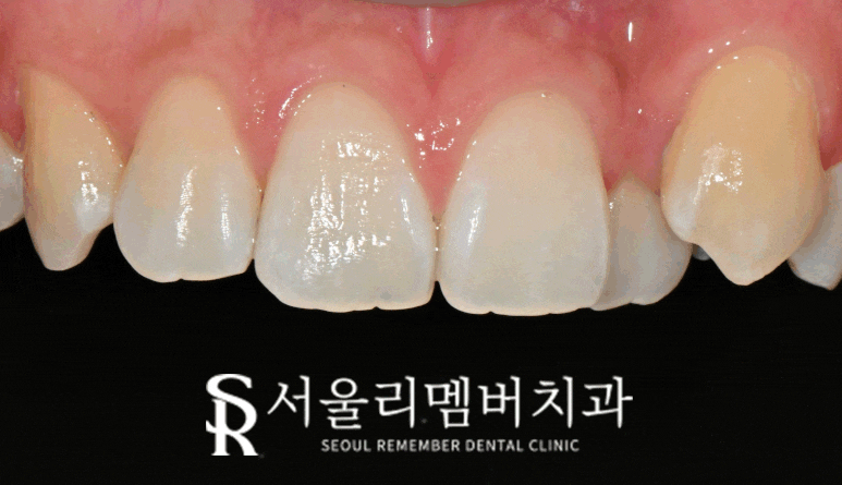 상도동 치과 송곳니 투스잼과 잔여 레진, 안전하고 스크래치 기스 흠집 없이 당일 제거할 수 있을까? 관련 이미지 2