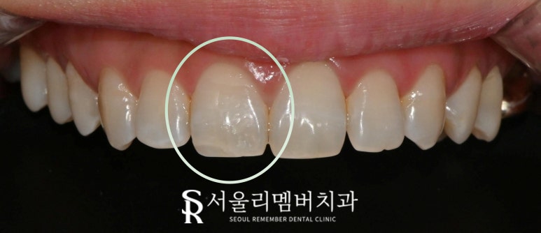 신림 치과 앞니 끝 절단연 깨짐 30분 만에 당일 파절 치아 레진 치료 관련 이미지 3