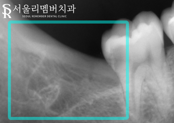 관악구 치과 원인을 알 수 없는 치통, 매복되어 있는 사랑니 때문? 관련 이미지 3