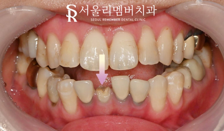아래 앞니 부러짐 뿌리 끝 염증 봉천동 치과 하악 4전치 발치 후 오스템 임플란트 관련 이미지 3