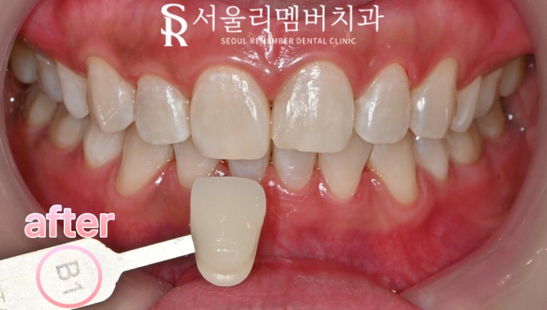 Can Teeth Be Brightened with Scaling and Whitening in One Day on the Same Day? Bongcheon-dong Dentist image 3