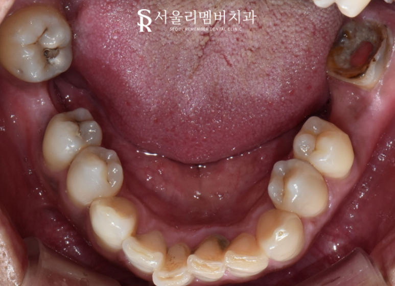 임플란트와 치아교정, 동시에 치료받을 수 있을까요? 남성역 서울 리멤버 치과 관련 이미지 3