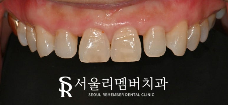 Restore a Natural, Even Smile with No-Prep Realnate! Laminate Veneers for Front Teeth at a Seoul National University Entrance Station Dental Clinic image 1