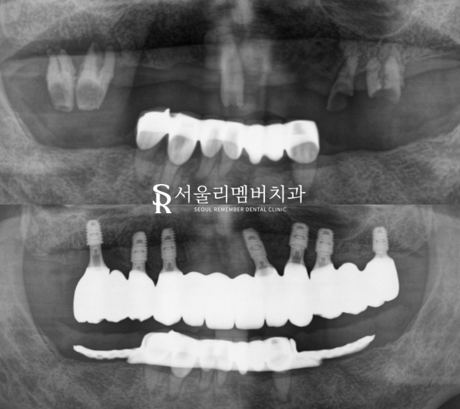 앞니 송곳니 어금니 윗니 전체 임플란트 성공 케이스 "서울대입구역 치과" 관련 이미지 6