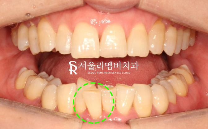 40대 교정 지금 시작해도 늦지 않을까요? 서울대입구역 치과 관련 이미지 5