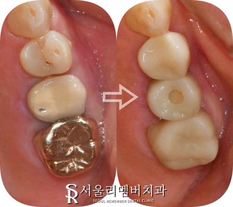 봉천역 치과 어금니 보철 후 음식물 끼임 및 치아 파절, 신경치료 크라운 및 임플란트 관련 이미지 8