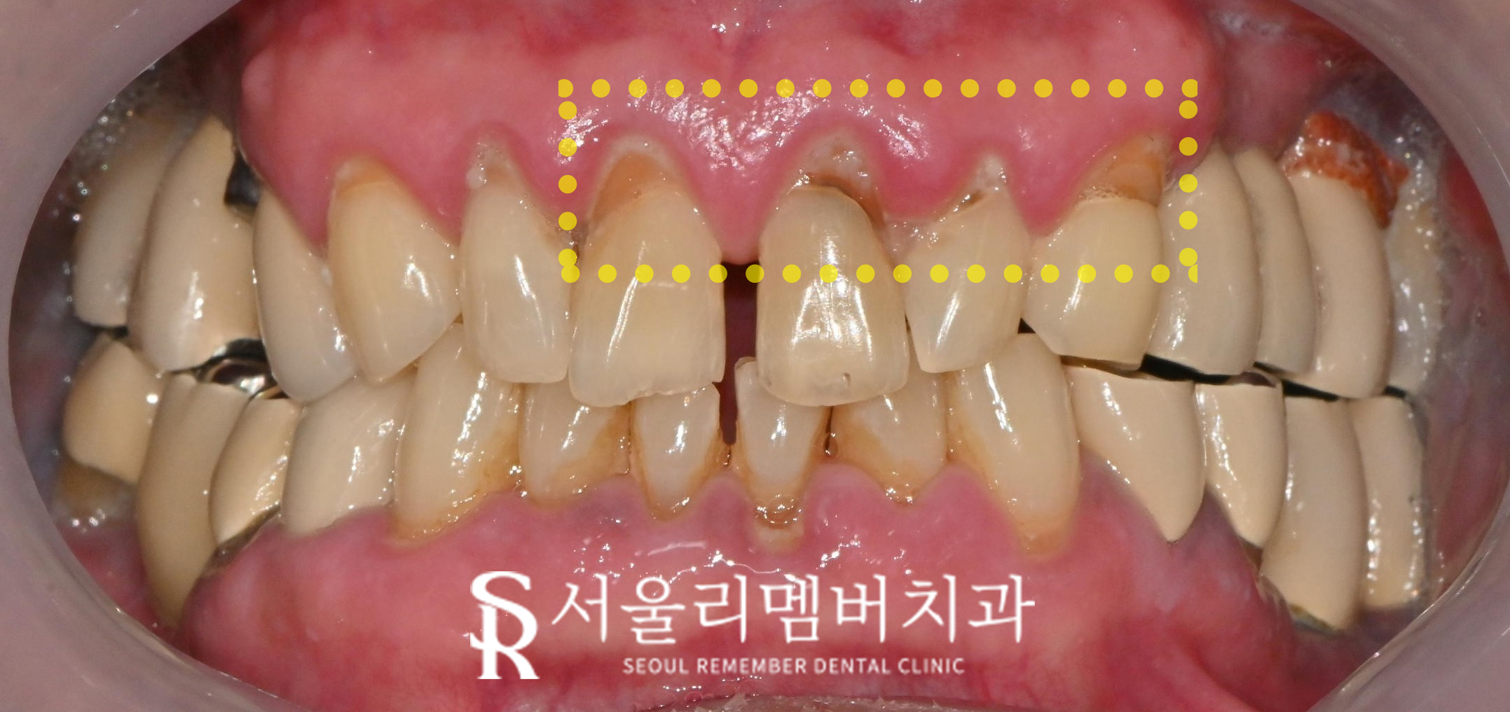 임플란트 및 크라운 으로 구강 환경 개선하는 방법 - 서울대입구역 치과 관련 이미지 4