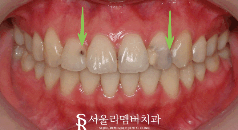 봉천동 치과 에서 충치치료 어금니 레진 수복 후기 관련 이미지 2