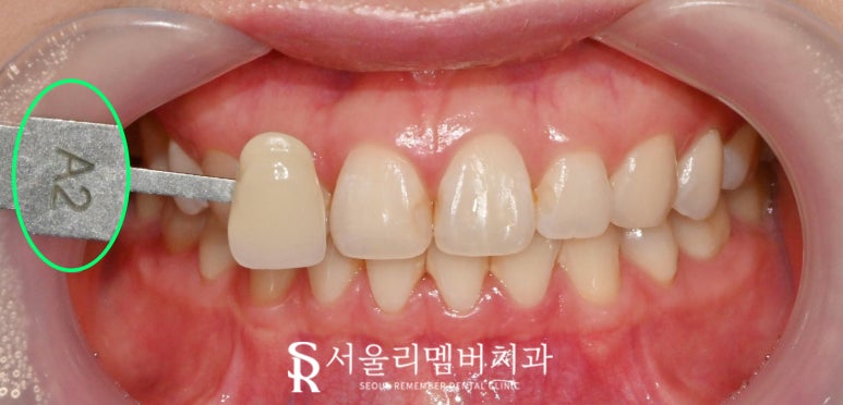 봉천역 치과 원데이 당일 치아미백 (쉐이드 가이드 기준 A2 &rarr; B1 전후 비교) 관련 이미지 1