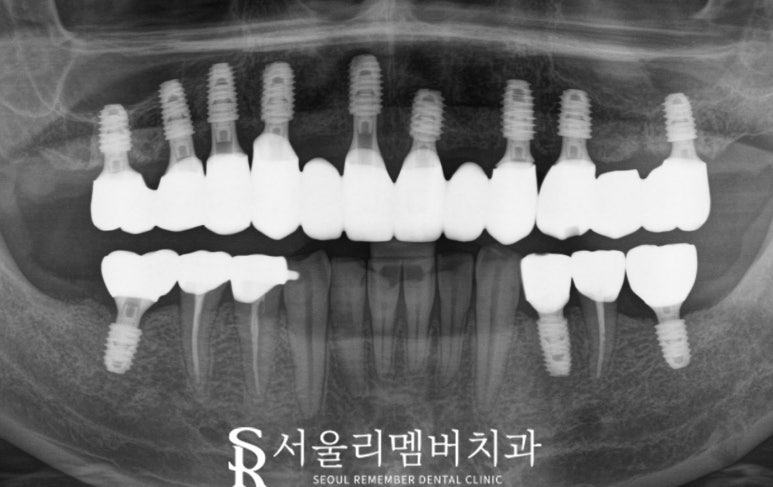 믿고 맡길 수 있는 신대방 치과 전체 임플란트 관련 이미지 3