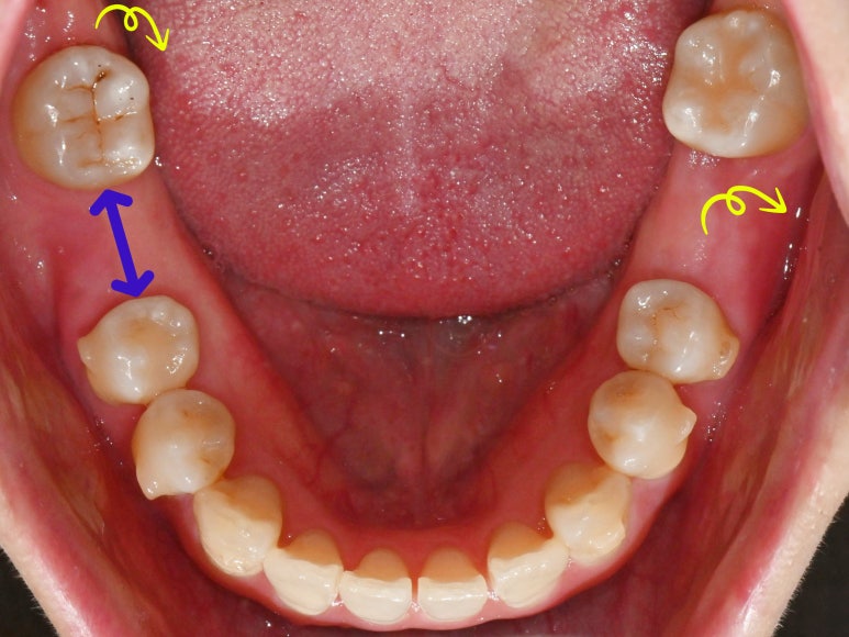 선천적 영구치 결손으로 남아있는 만기 잔존 유치, 서울대입구역 교정 치과 에서 투명 인비절라인 & 임플란트 케이스 관련 이미지 6